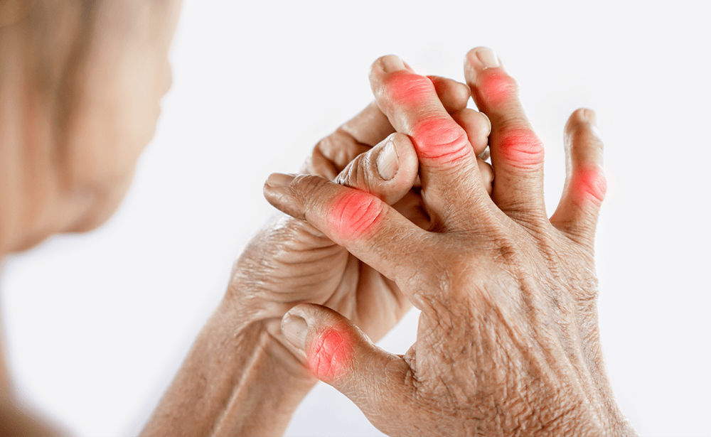 Arthritis management