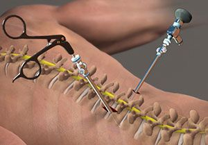 Endoscopic disc removal procedure