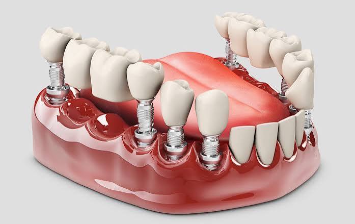 Fixed and Removable Dentures