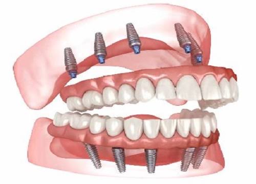 Full Mouth Rehabilitation