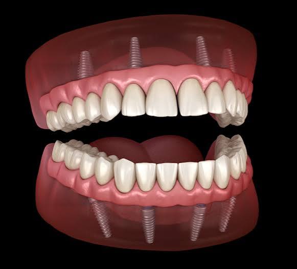Implant-Supported Dentures