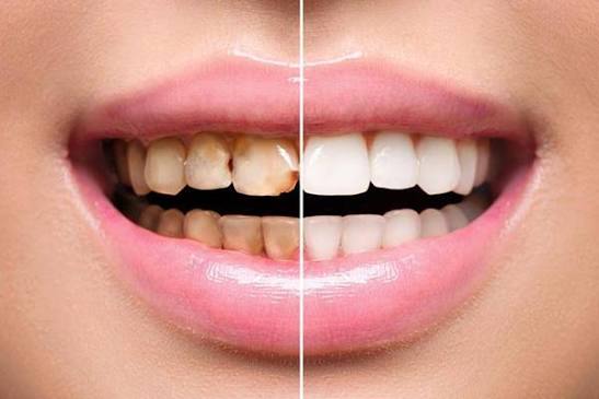 Laminate Veneers